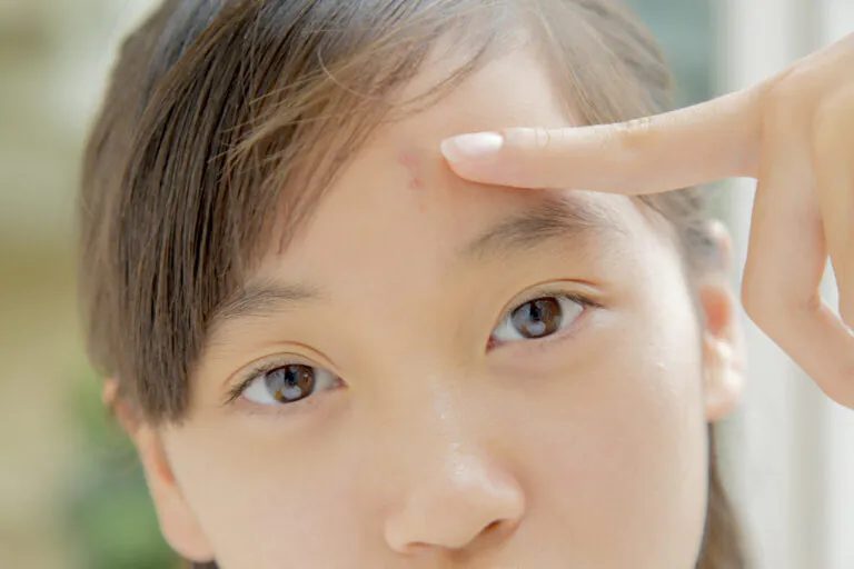 ニキビがある子供